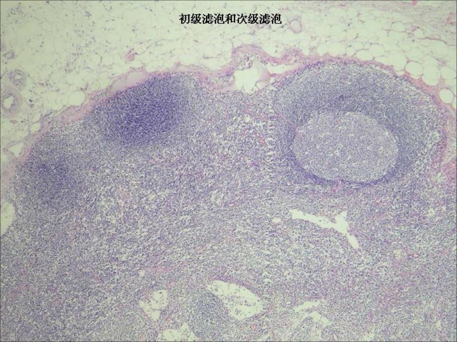 淋巴瘤ppt课件_第4页