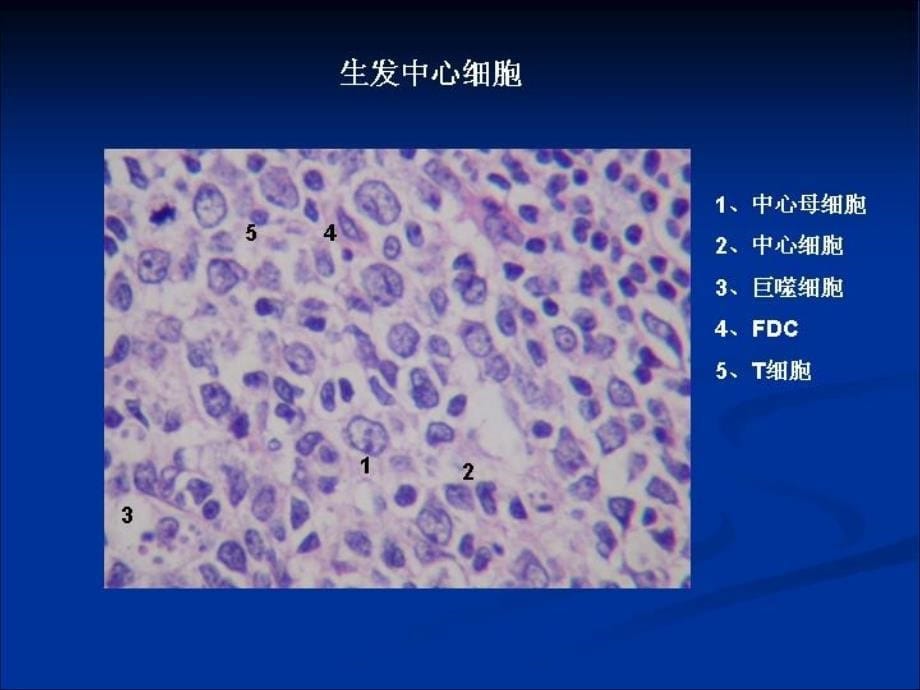 淋巴瘤ppt课件_第5页