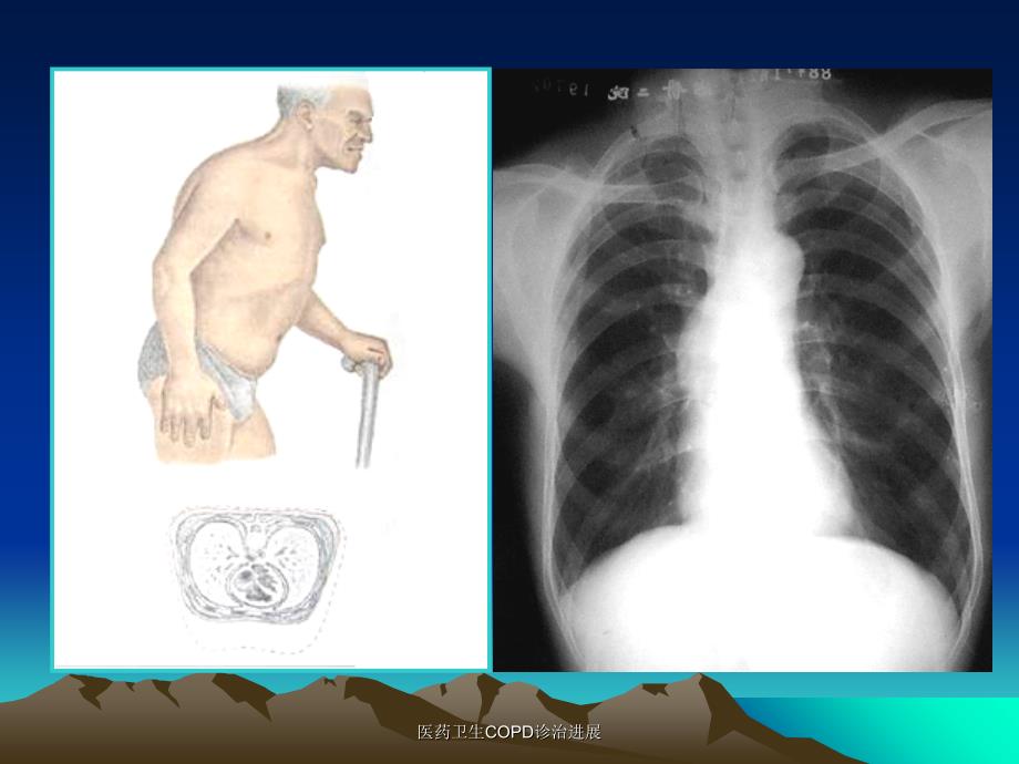 医药卫生COPD诊治进展课件_第2页