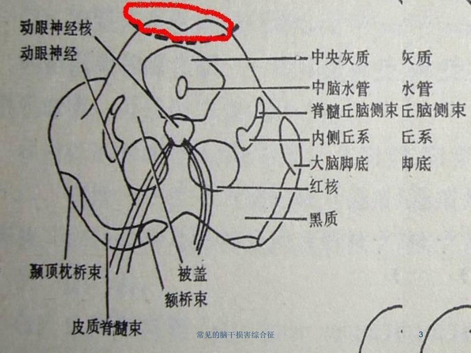 常见的脑干损害综合征培训课件_第3页