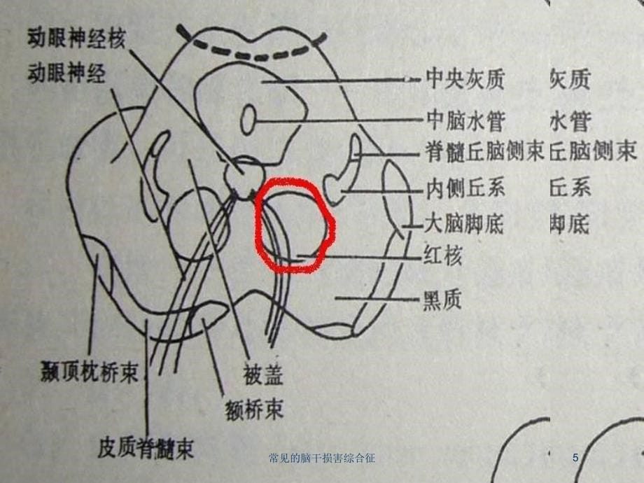 常见的脑干损害综合征培训课件_第5页