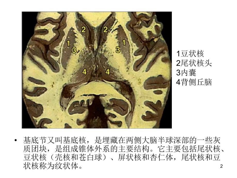 双侧基底节区对称性病变PPT课件_第2页