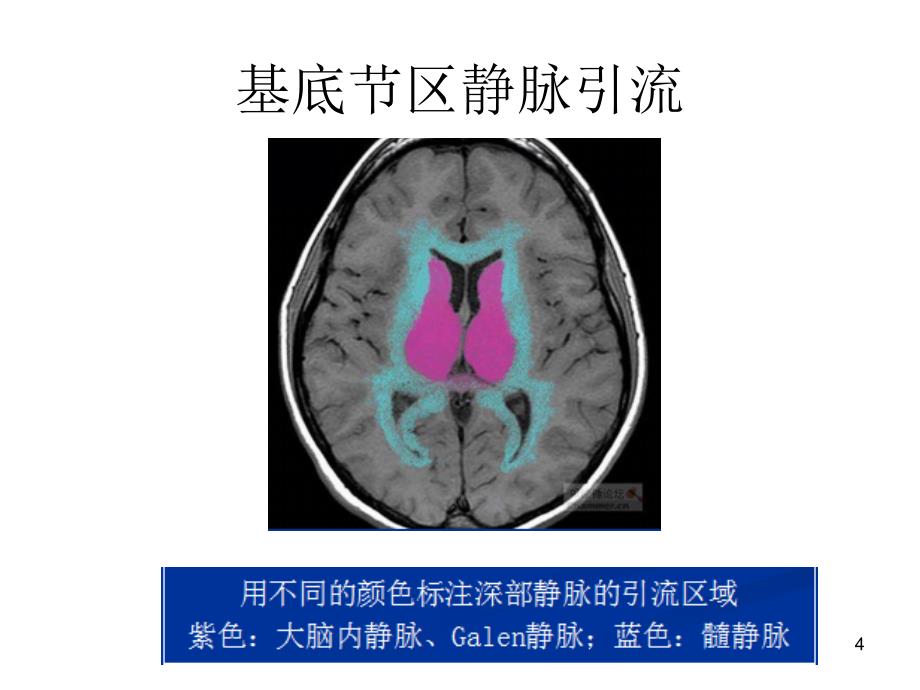 双侧基底节区对称性病变PPT课件_第4页