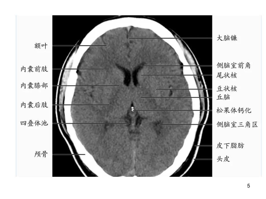 双侧基底节区对称性病变PPT课件_第5页