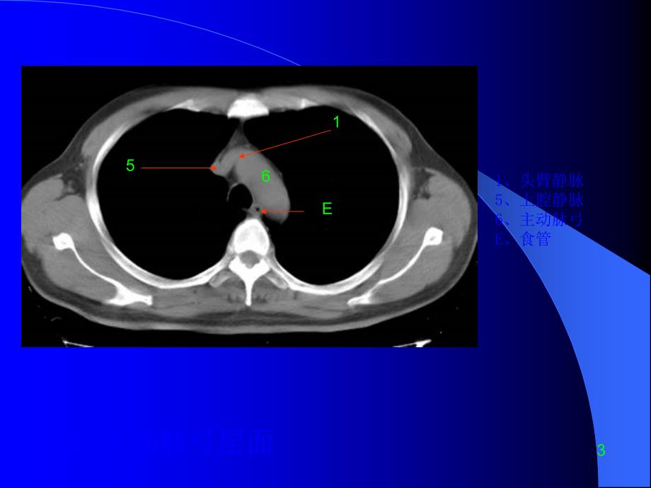 胸部CT诊断.ppt_第4页