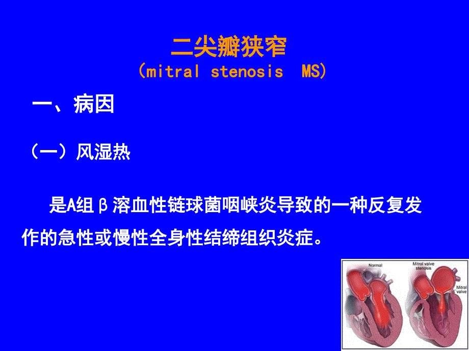 心脏瓣膜病(二尖瓣狭窄)_第5页