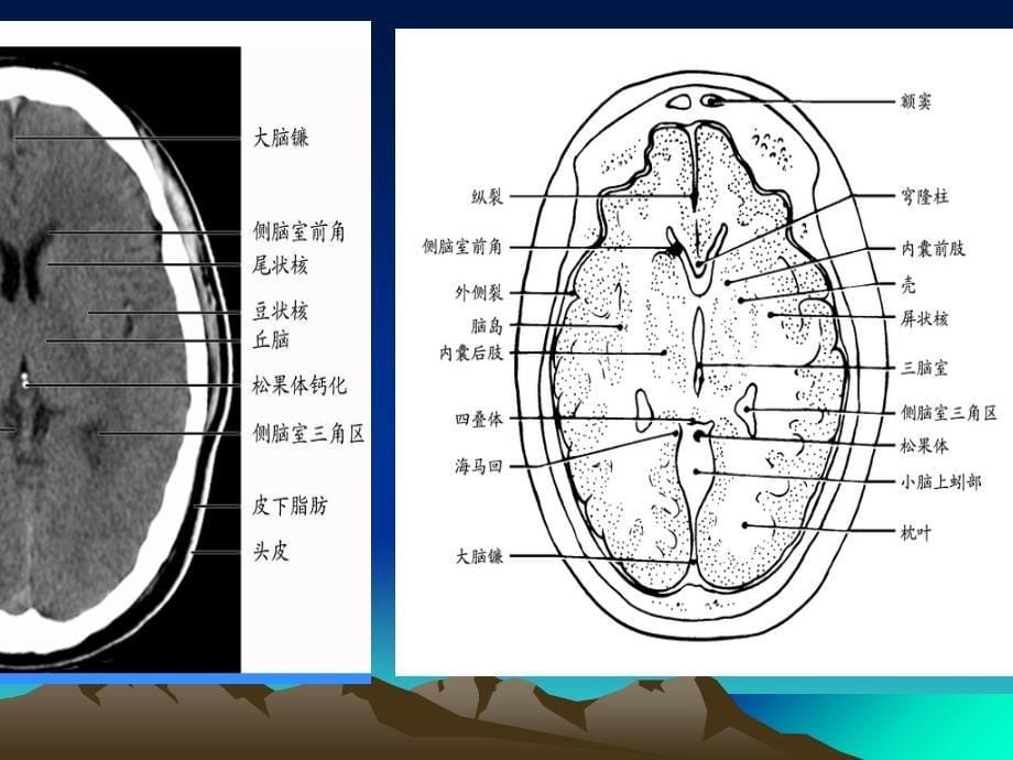 精品中枢神经系统影像诊断学课件精品ppt课件_第5页