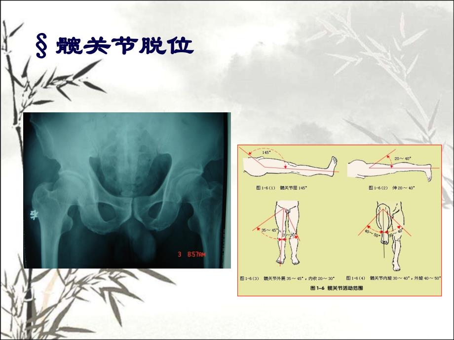 下肢骨与关节损伤PPT课件_第3页