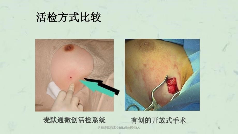 乳腺麦默通真空辅助微创旋切术课件_第5页