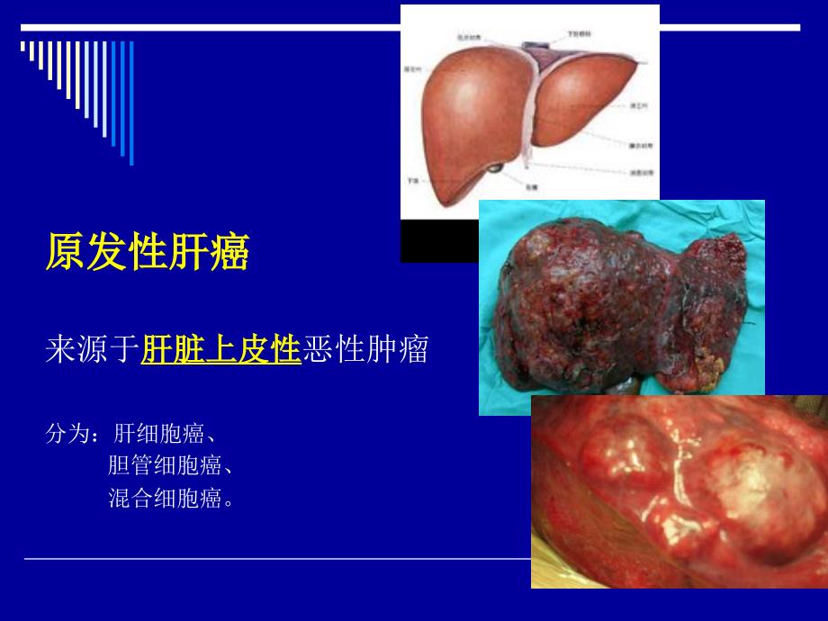 肝癌射频消融及介入治疗 ppt课件_第4页