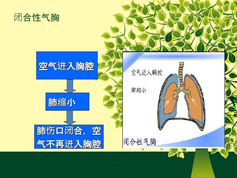 张力性气胸 PPT课件_第5页