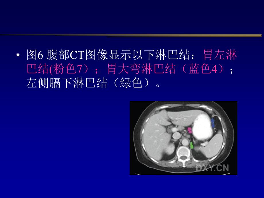 胃癌淋巴结及CT表现课件_第4页