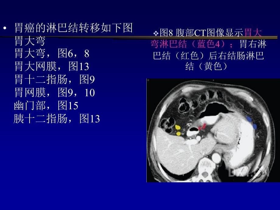 胃癌淋巴结及CT表现课件_第5页