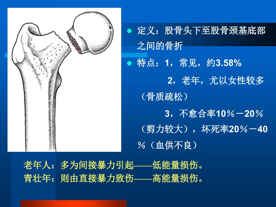 《股骨颈骨折》PPT课件_第2页