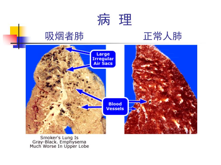 慢性支气管炎课件PPT_第4页