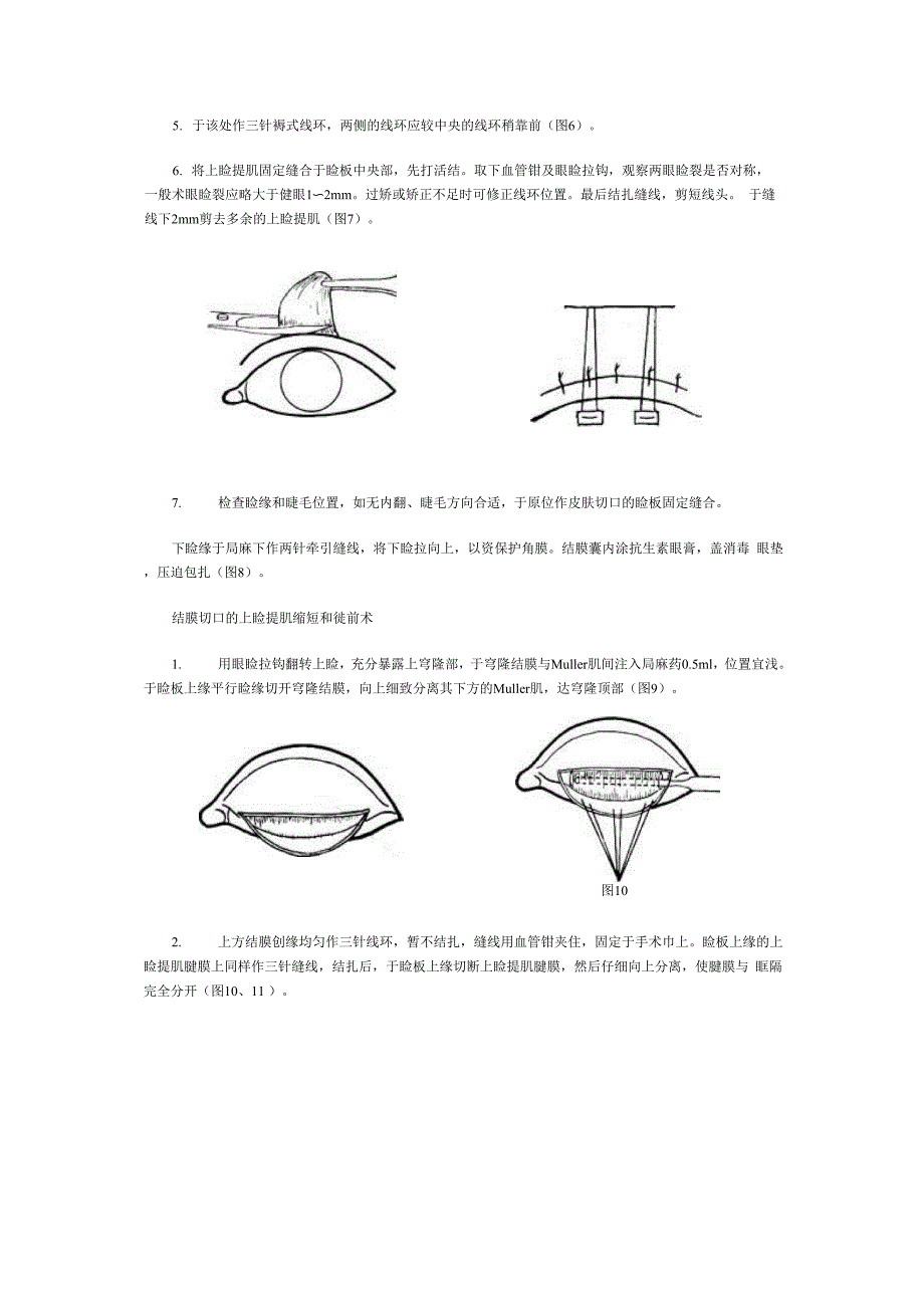 上睑提肌缩短和徙前术_第3页