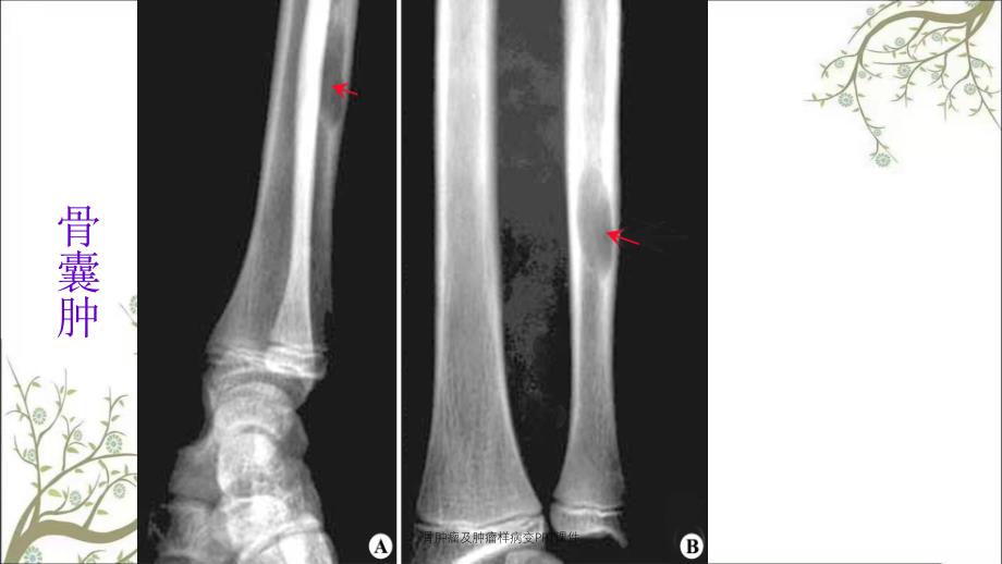 骨肿瘤及肿瘤样病变PPT课件_第4页