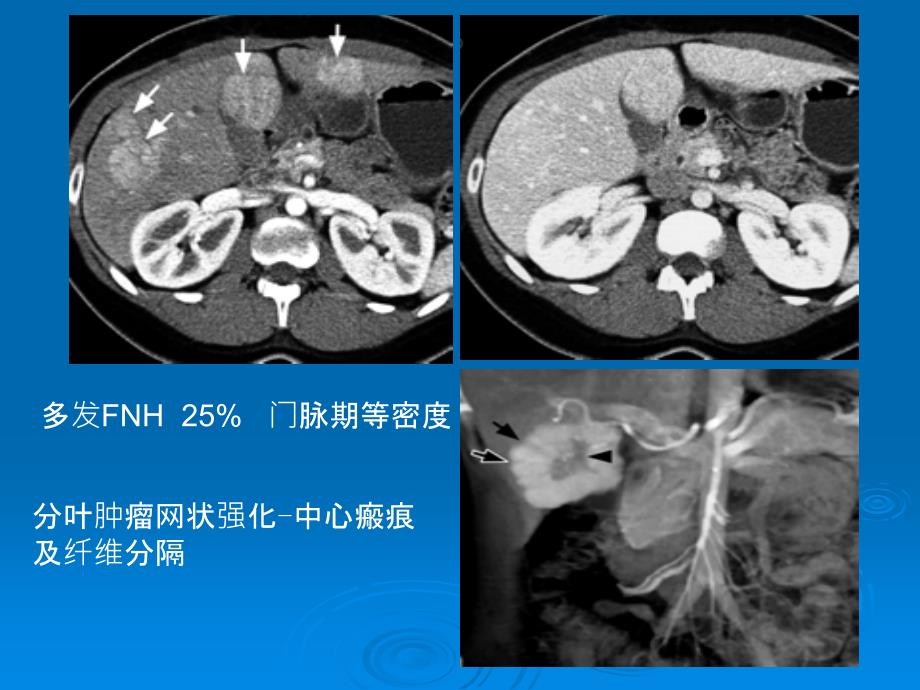 肝脏少见病变和征象_第3页