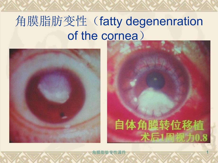 角膜脂肪变性课件_第1页