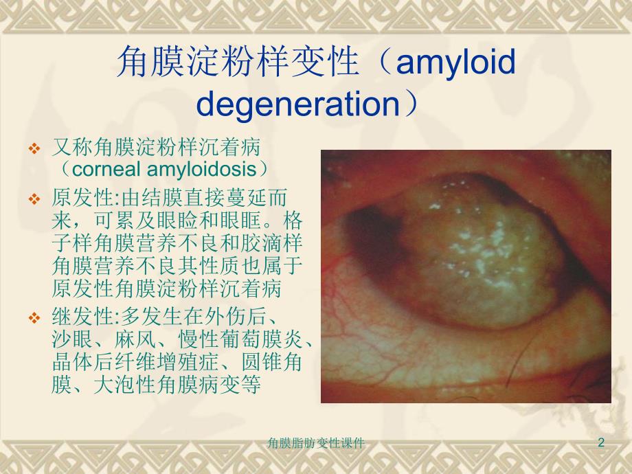 角膜脂肪变性课件_第2页