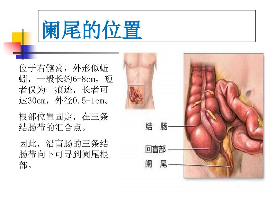 《急性阑尾炎精品》PPT课件_第3页