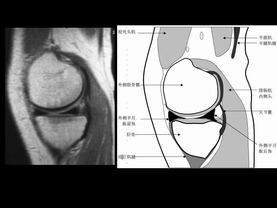 半月板和韧带核磁共振诊断ppt课件_第4页