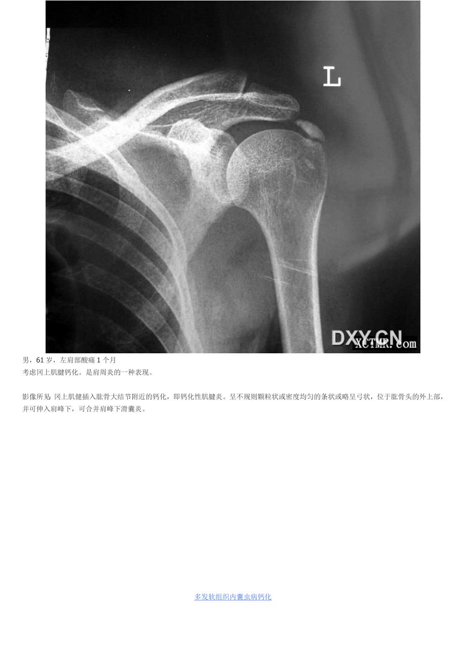 医学影像学专题骨及软组织钙化_第2页