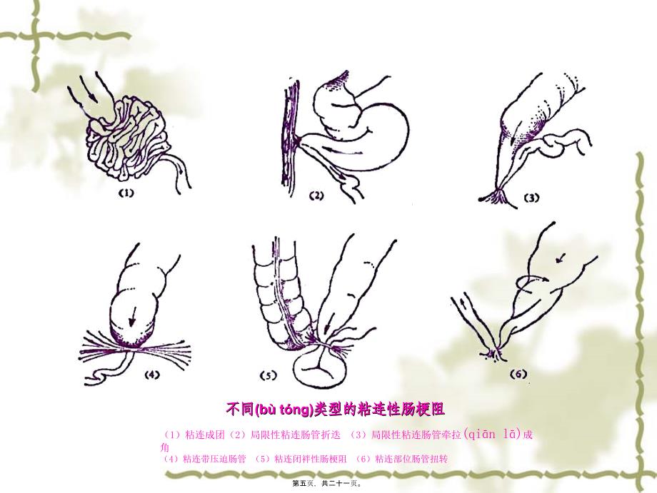 医学专题—粘连性肠梗阻35560_第5页