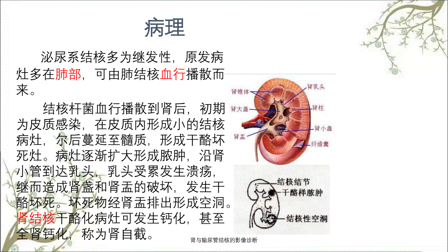 肾与输尿管结核的影像诊断_第2页