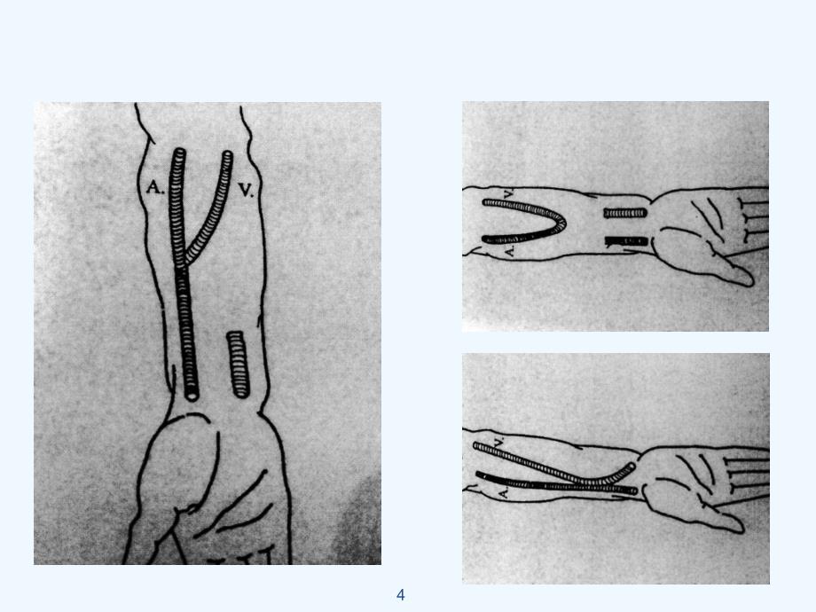 动静脉内瘘的穿刺与护理课件_第4页