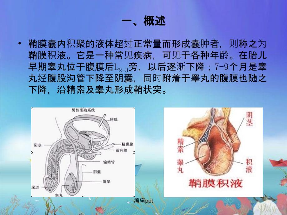 鞘膜积液业务学习_第2页