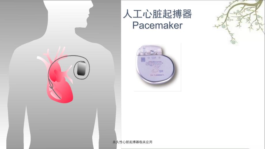 永久性心脏起搏器临床应用_第2页