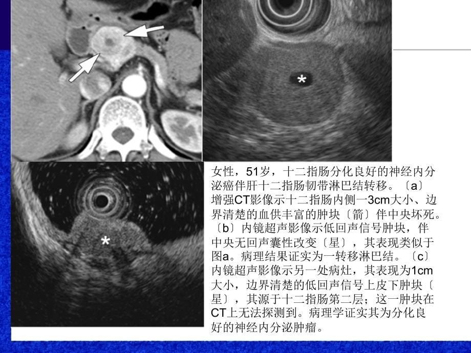 《胃肠道上皮下肿瘤》PPT课件_第5页