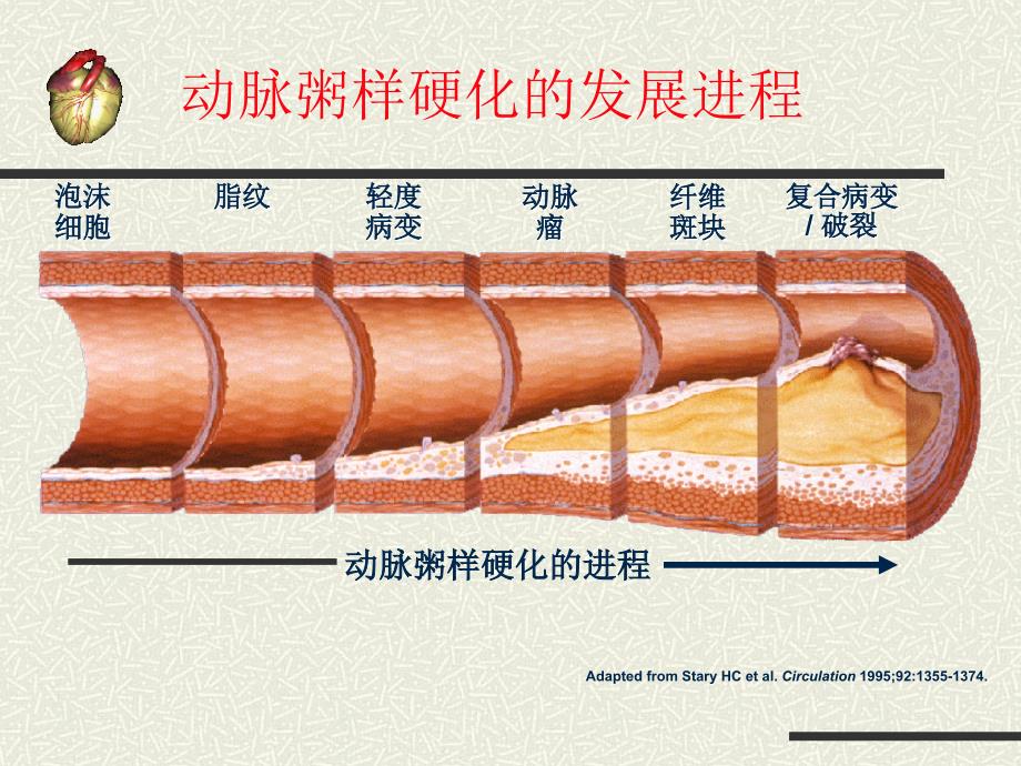 急性心肌梗死护理课件ppt_第4页