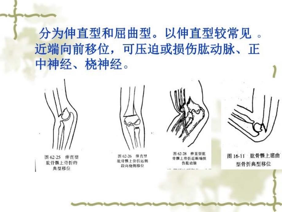 最新常见四肢骨折病人的护理ppt课件PPT课件_第3页