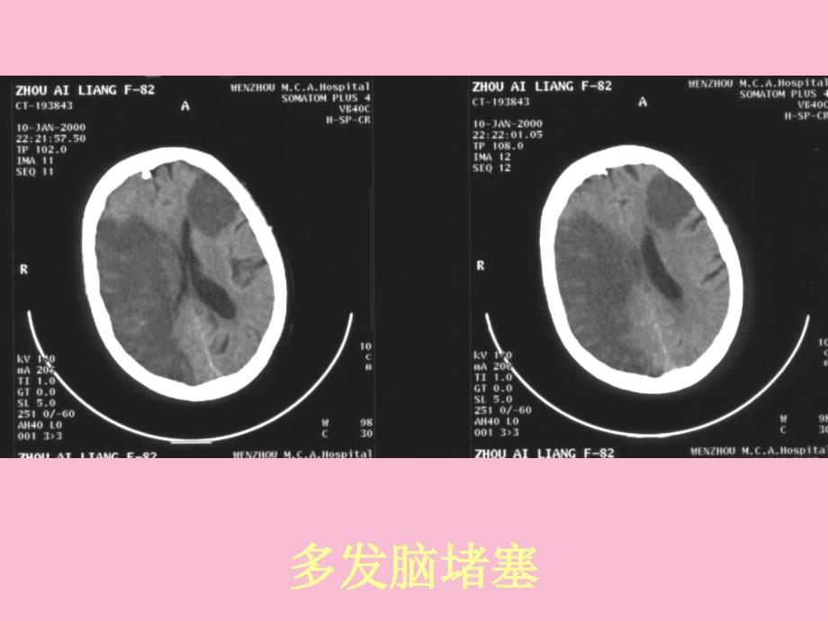 常见疾病的ct片实习版ppt课件_第2页