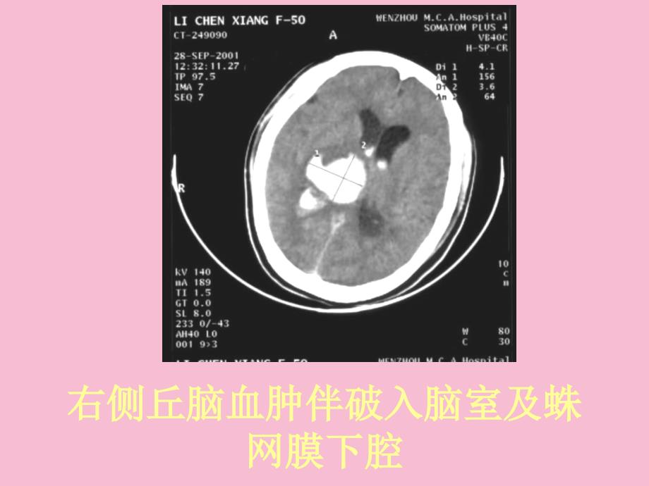 常见疾病的ct片实习版ppt课件_第3页