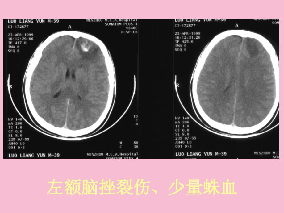 常见疾病的ct片实习版ppt课件_第4页