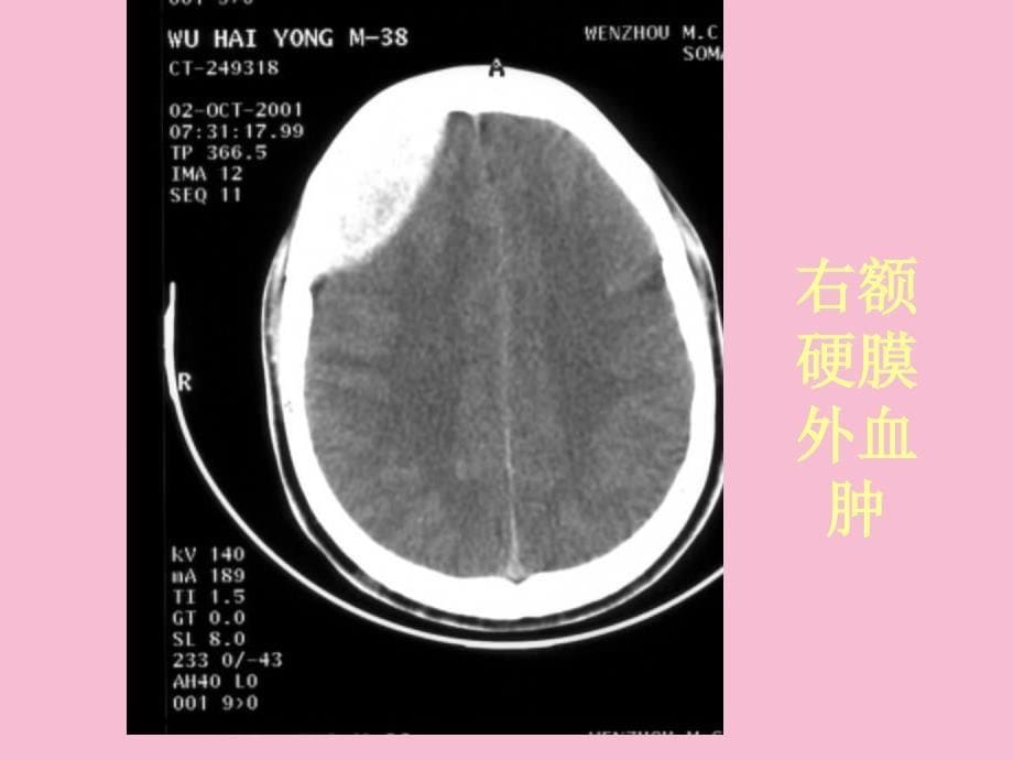 常见疾病的ct片实习版ppt课件_第5页