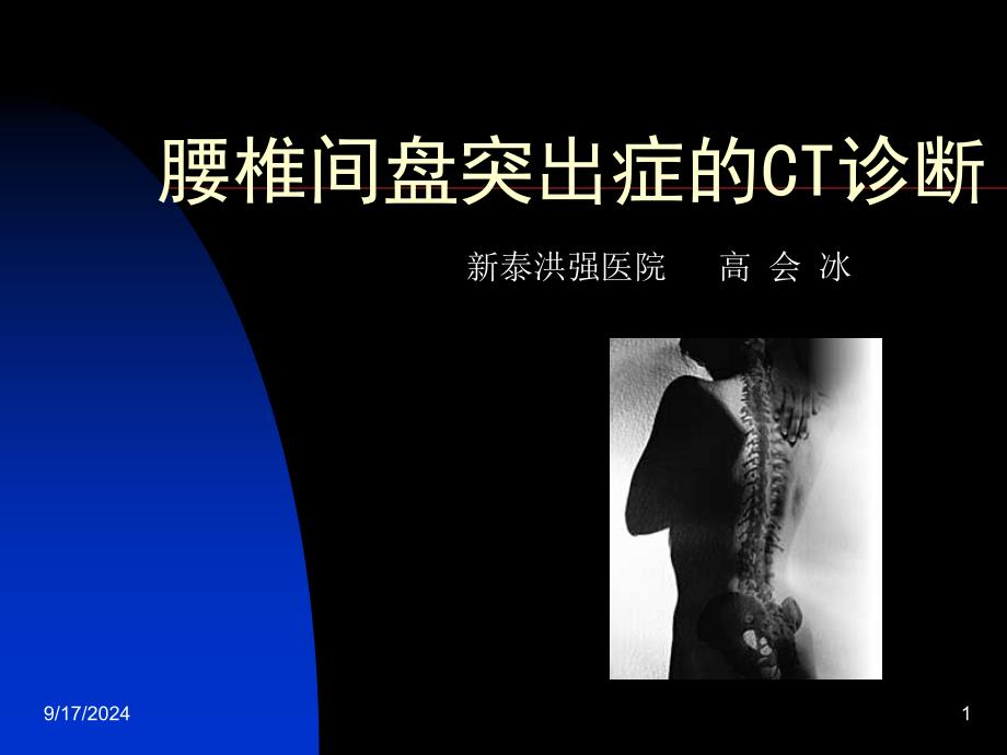 椎间盘突出症的CT表现高会冰_第1页