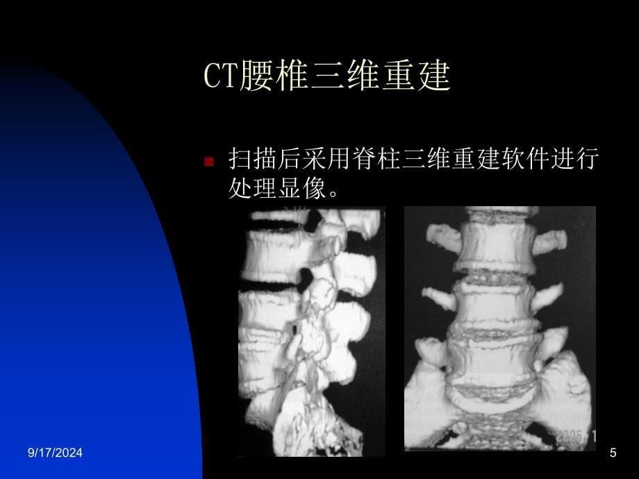 椎间盘突出症的CT表现高会冰_第5页