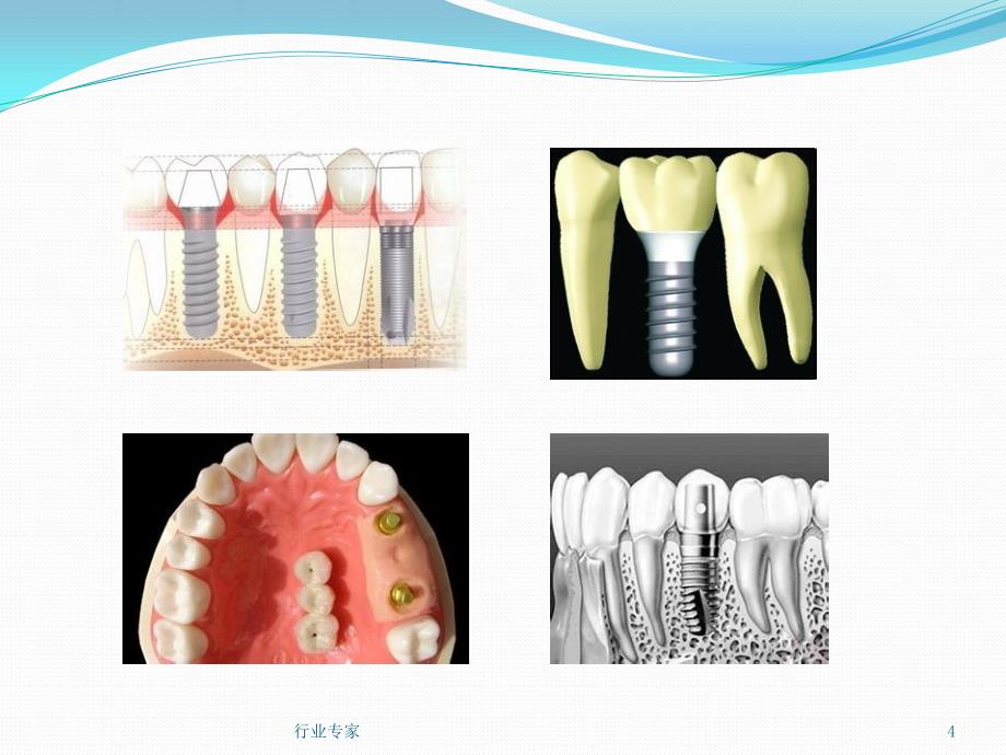 种植义齿概述行业严选_第4页