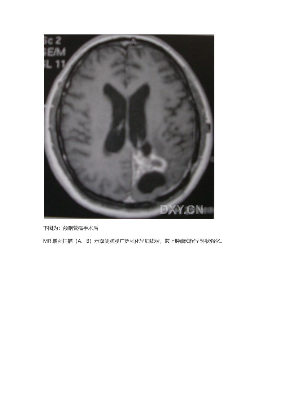 MRI影像“脑膜强化”的疾病复习重点讲解_第3页