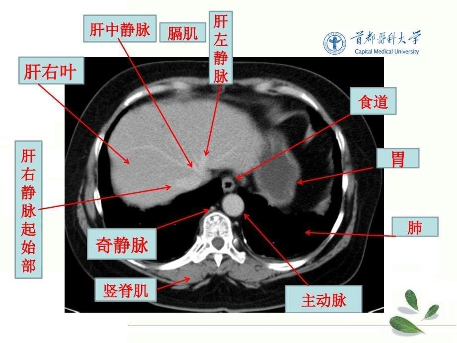 腹部断层解剖学 第三节腹部横断层解剖1_第5页