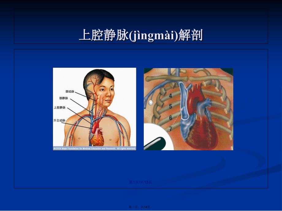 上腔静脉综合征患者的护理学习教案_第2页