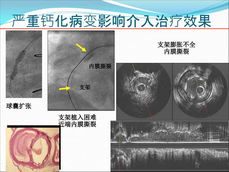 钙化病变的处理策略和技巧_第4页