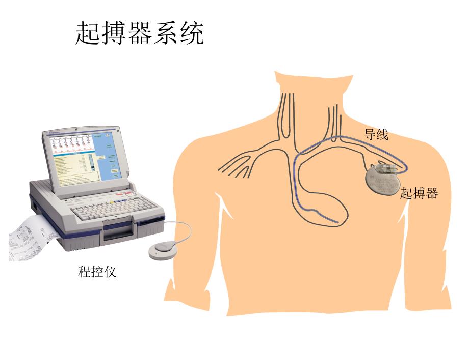 起搏器植入常见并发症及处理课件_第4页