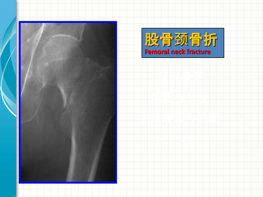 股骨颈骨折PPT课件02_第1页