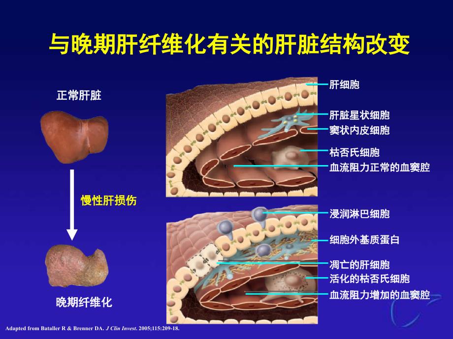 慢乙肝肝硬化治疗新策略_第4页