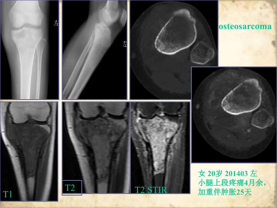 最新：恶性骨肿瘤鉴别诊 终板文档资料_第4页